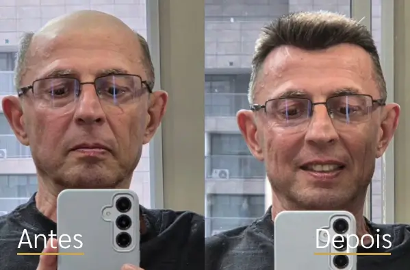 Resultado real de prótese capilar antes e depois do cliente 10