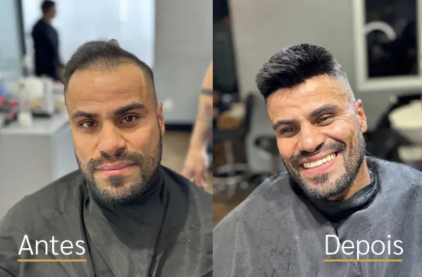 Resultado real de prótese capilar antes e depois do cliente 4