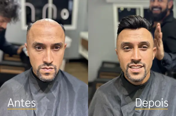 Resultado real de prótese capilar antes e depois do cliente 5