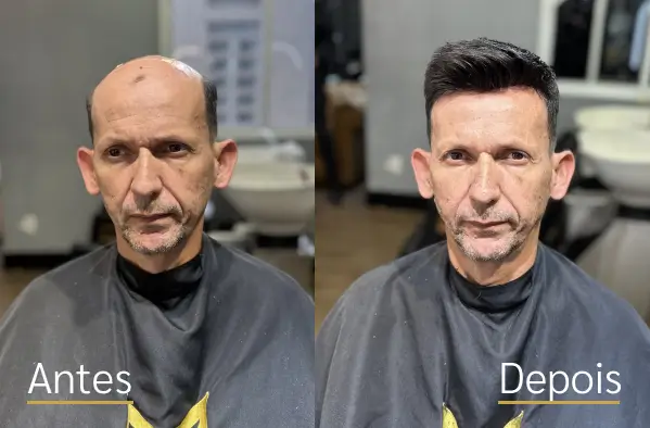 Resultado real de prótese capilar antes e depois do cliente 9